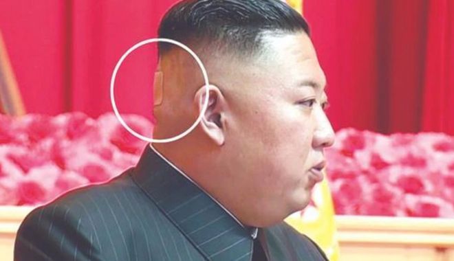 Bandajul de pe ceafa lui Kim Jong Un ridică multe semne de întrebare