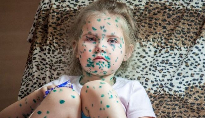 Boli contagioase. Scarlatina debutează brusc cu febră şi frisoane