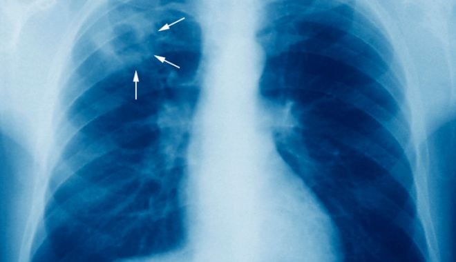 Tuberculoza poate fi transmisă printr-o simplă respirație
