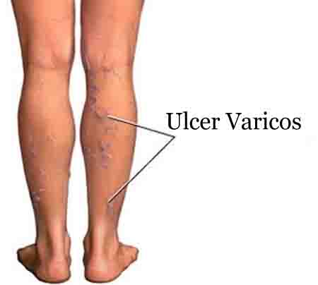 Poate fi bolnav cu piciorul varicos, Ulcer varicos – ce este, simptome, tratament